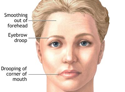 gravis myasthenia mg